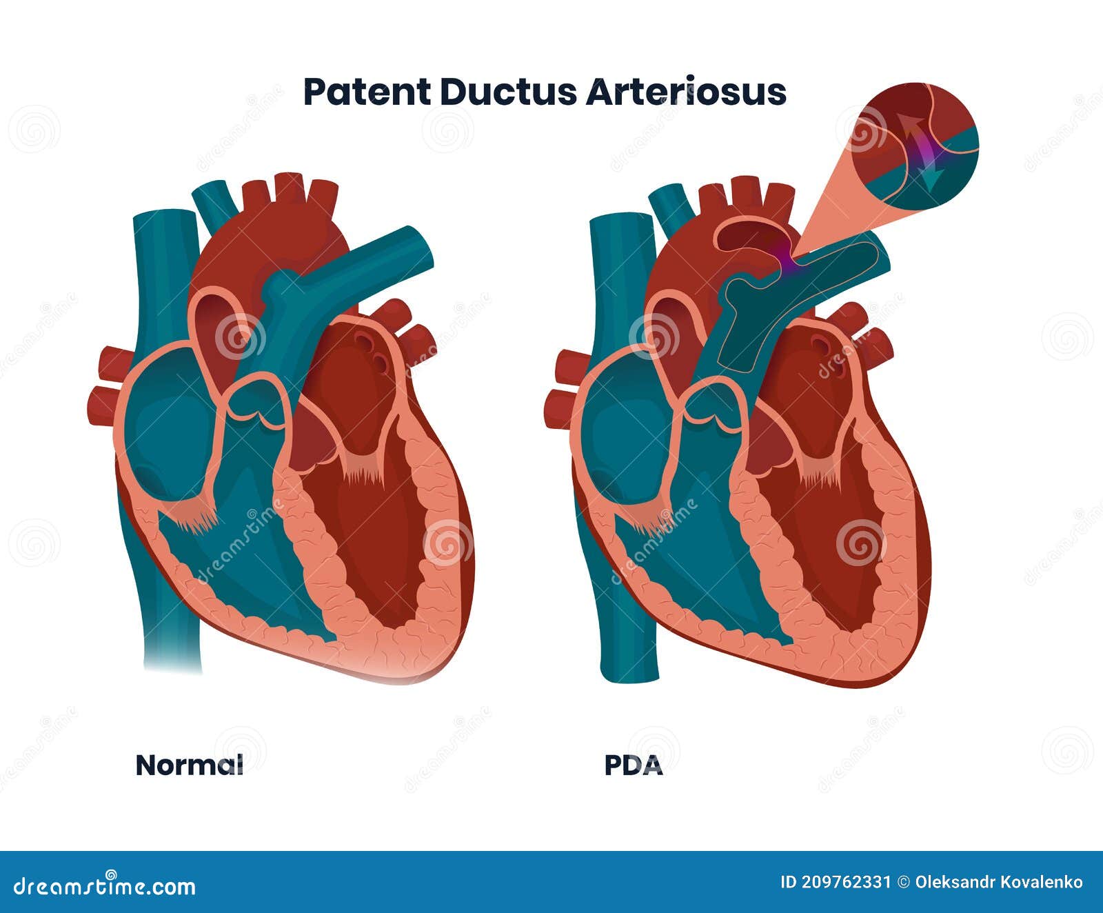 Как лечат открытое овальное окно в сердце и нужно ли оперировать?