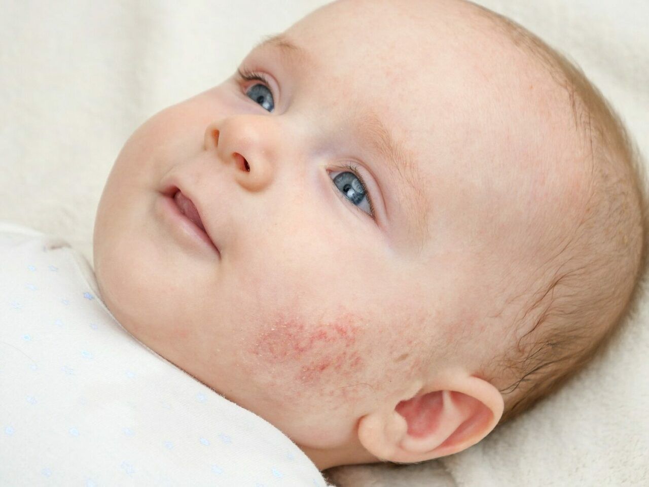 Что за сыпь? 13 видов сыпи у новорожденных и младенцев, которые вы должны знать