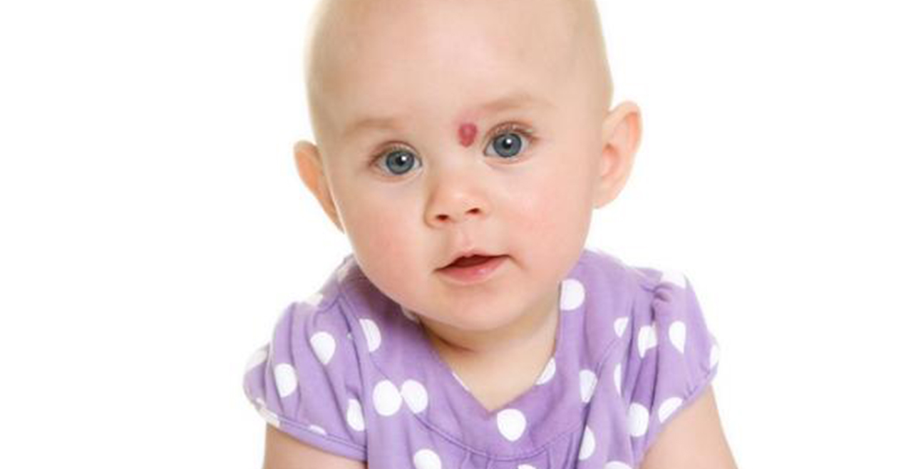 Причины и лечение детских гемангиом: что нужно знать родителям